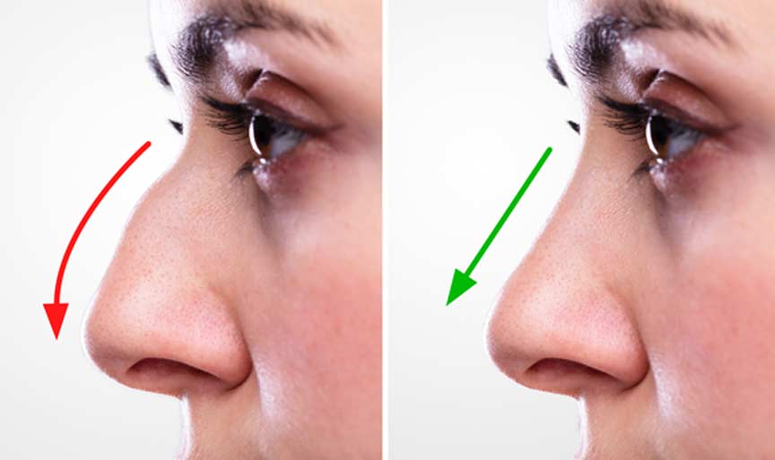 Septoplasty Treatment in Bilaspur Chhattisgarh